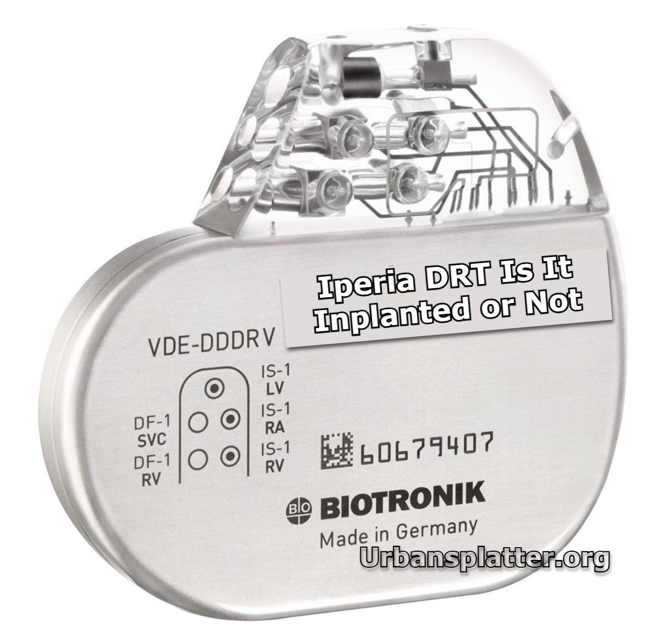 Iperia DRT Is It Inplanted or Not